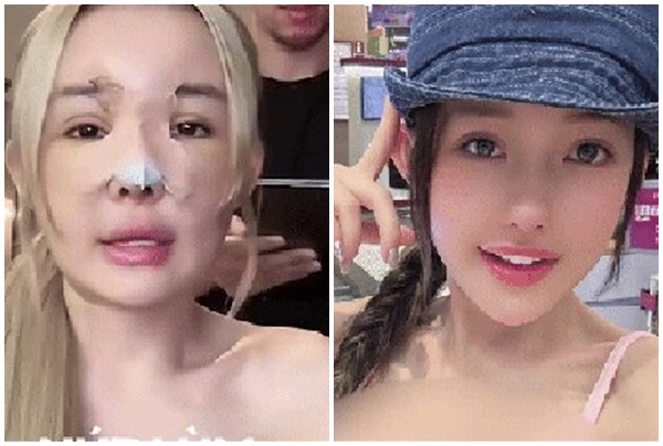 Ngân 98 “nghi.ệ.n” phẫu thuật thẩm mỹ, chuẩn bị “đ.ậ.p mặ.t xây lại” lần thứ 12 dù được cảnh báo có thể mang thương t.ậ.t vĩnh viễn: Phải sửa đẹp mới giữ được chồng chứ