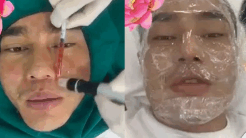 Sao nam Việt công khai chỉnh sửa mặt 10 ngày/lần, đang chạy bộ thì tụt s:ụn mũi: ‘Trong showbiz chỉ mình anh g:an lớn vậy!’”