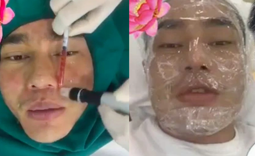 Sao nam Việt công khai chỉnh sửa mặt 10 ngày/lần, đang chạy bộ thì tụt s:ụn mũi: ‘Trong showbiz chỉ mình anh g:an lớn vậy!’”