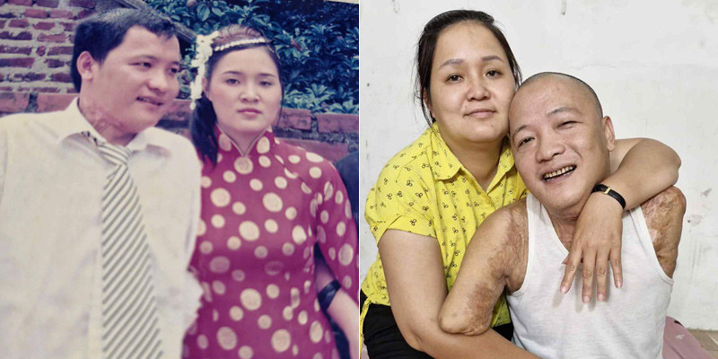 Mất 2 tay 1 chân, bị vợ đầu bỏ rơi – người đàn ông được “hồi sinh” nhờ tình yêu phi thường của vợ thứ 2: “Tôi mất tay chân và còn mất luôn cả vợ. Sau khi tôi xuất viện được 1 tuần, vợ bảo đi ăn cưới bạn thân ở quê rồi không quay về nữa”