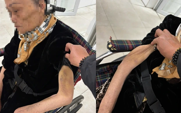 Thôi xong: Kết quả giám định xác định cụ bà 82 tuổi bị nữ giúp việc b:ạo h:ành –  g:ãy nhiều xư:ơng sư:ờn với thời điểm hình thành t:ổn thư:ơng khác nhau